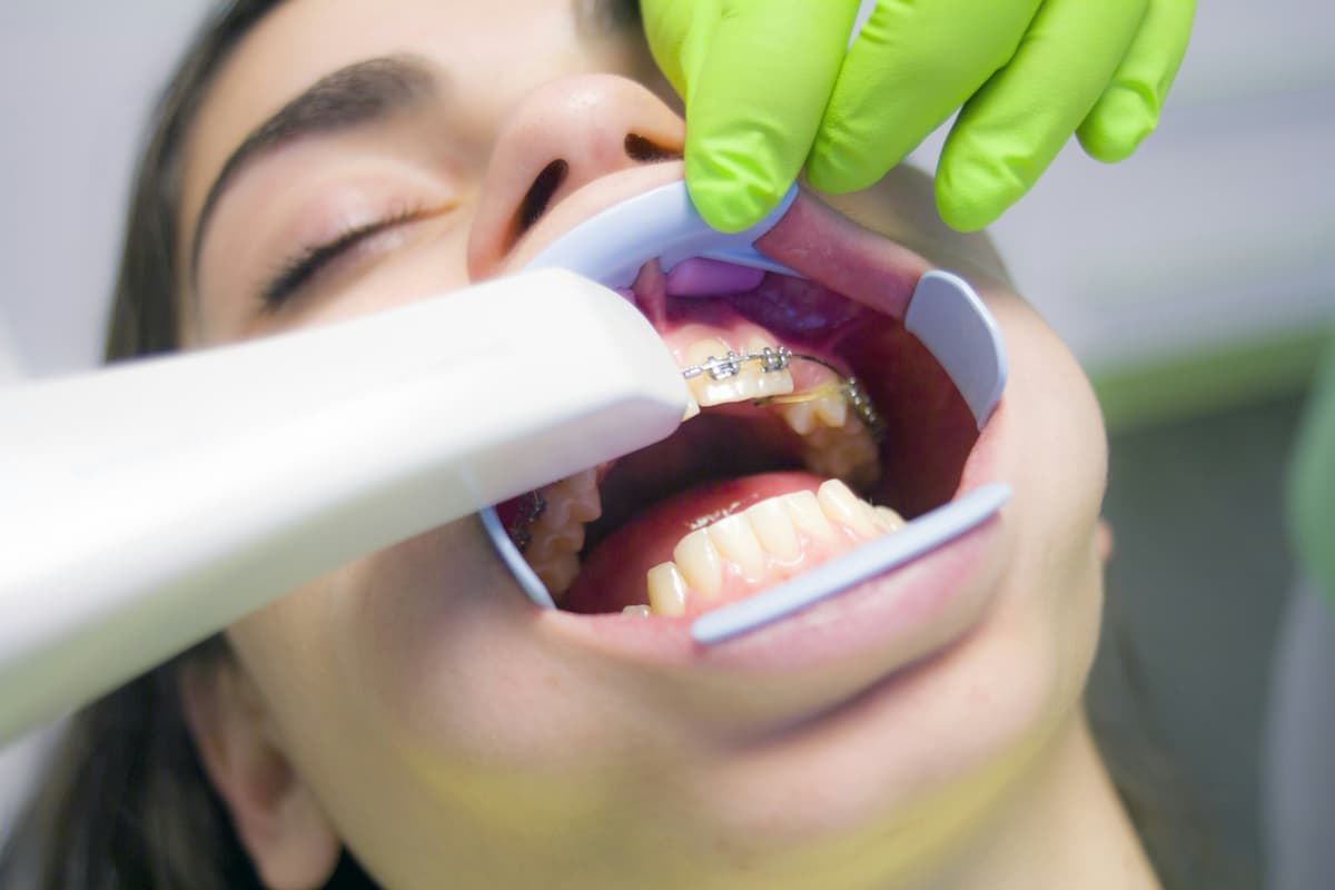 girl with braces getting cleaning