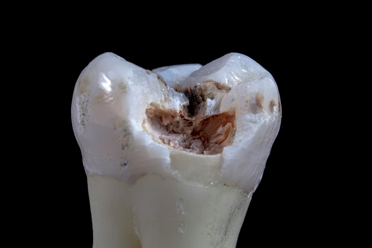 broken tooth with gap on reverse side