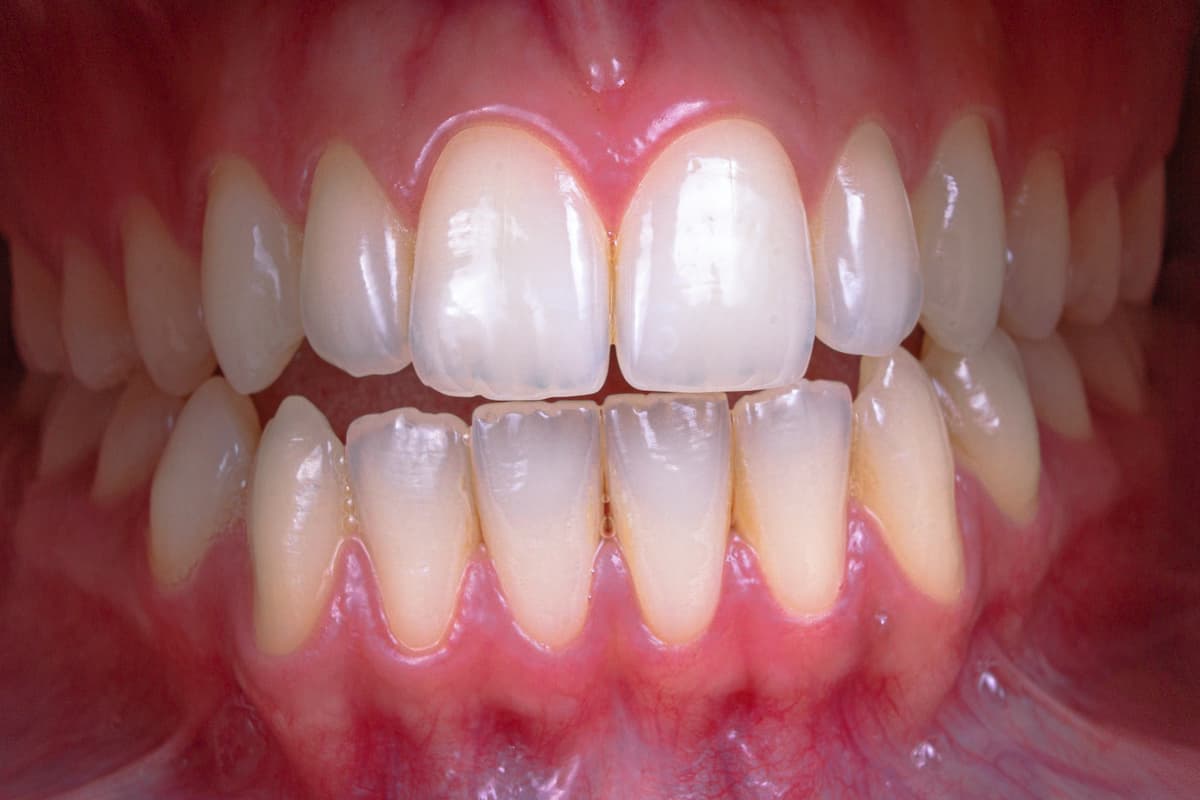 white smile after flouride treatment