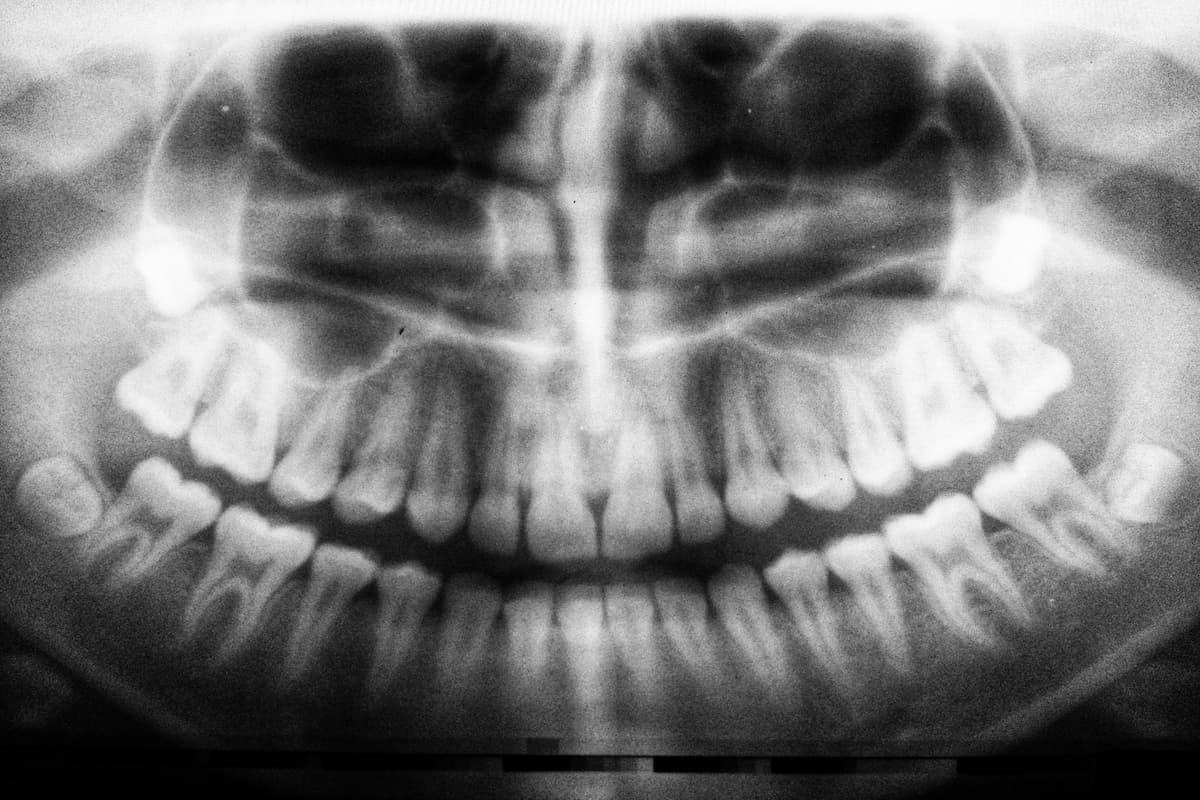 person getting xray exam of teeth